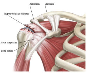 Chirurgie De La Coiffe Des Rotateurs Ortho Com